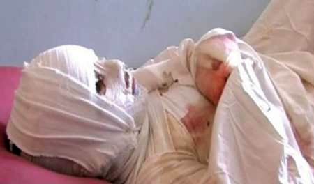 خرید پانسمان‌های سوختگی به دلیل تحریم‌ها منتفی است