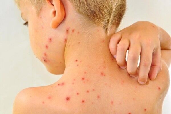 شناسایی اولین مورد ابتلا به سرخک در قم


