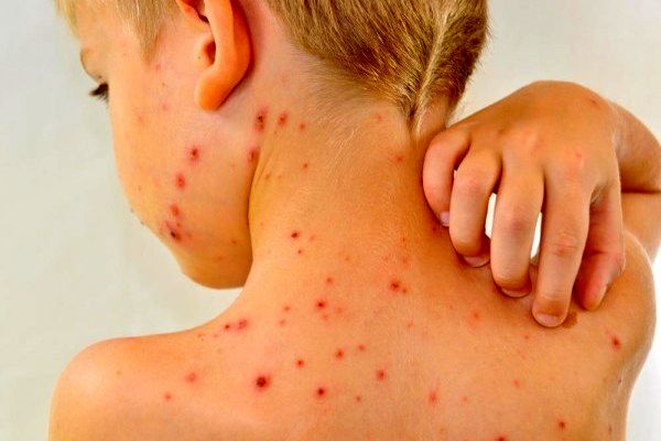شناسایی اولین مورد ابتلا به سرخک در قم

