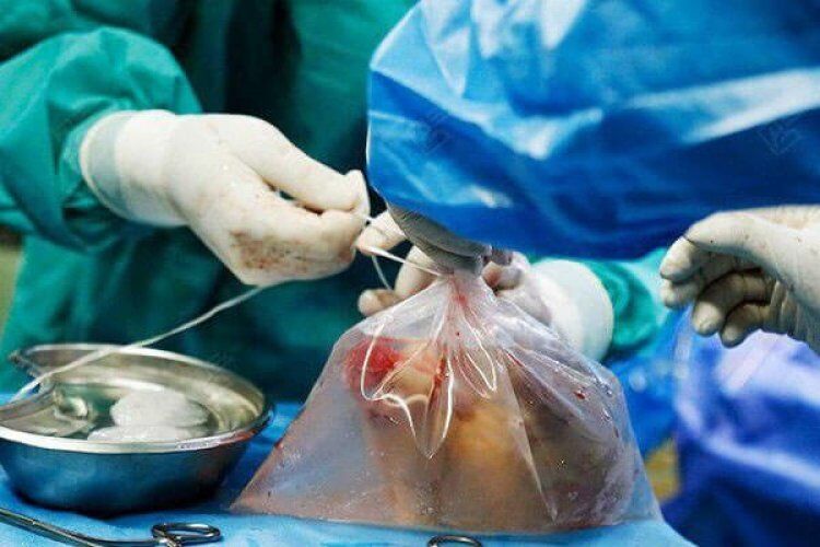 مرگ روزانه ۷ تا ۱۰ بیمار به دلیل نرسیدن عضو پیوندی