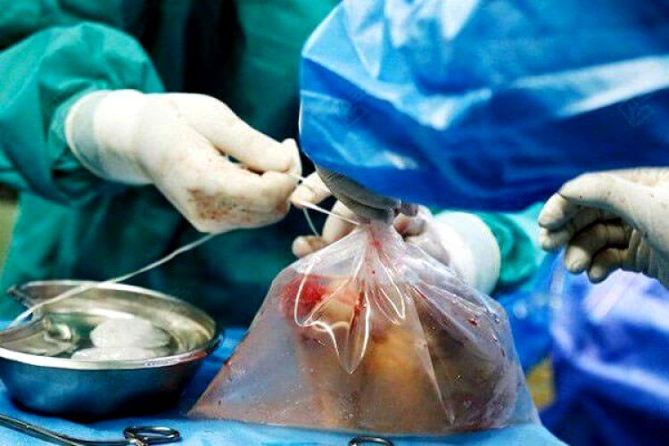 مرگ روزانه ۷ تا ۱۰ بیمار به دلیل نرسیدن عضو پیوندی