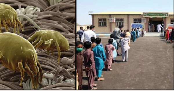 حدود 10درصد دانش‌آموزان زاهدان مبتلا به اگزما هستند