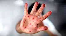 
احتمال خطر همه‌گیری سرخک در کشور