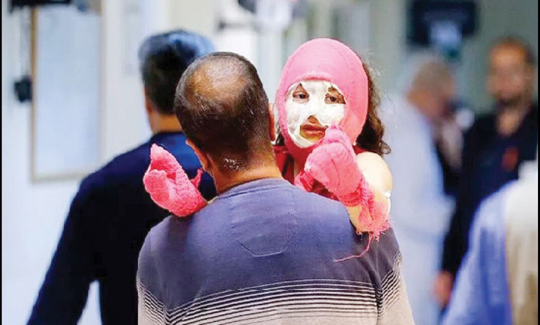 
دست و صورت؛ بیشترین سوختگی‌ها در حوادث چهارشنبه‌سوری