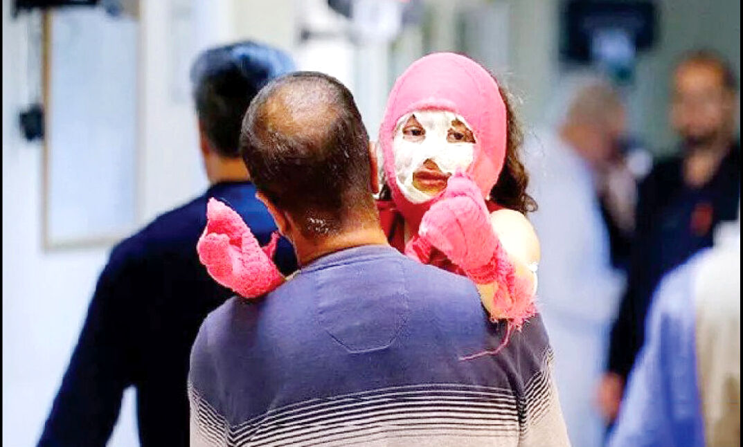 
دست و صورت؛ بیشترین سوختگی‌ها در حوادث چهارشنبه‌سوری